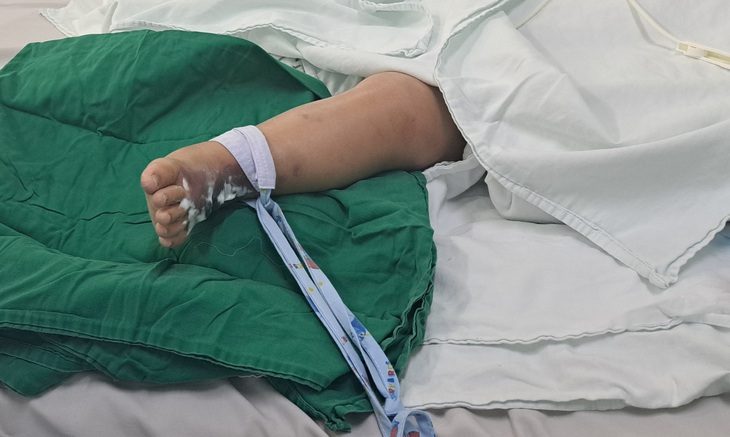 Vết thương ở chân của bé trai 22 tháng tuổi bị rắn hổ mèo cắn - Ảnh: Bệnh viện cung cấp
